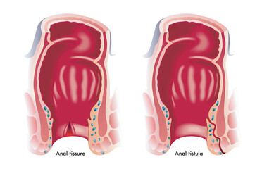 Get the Right Care for Anal Fissure